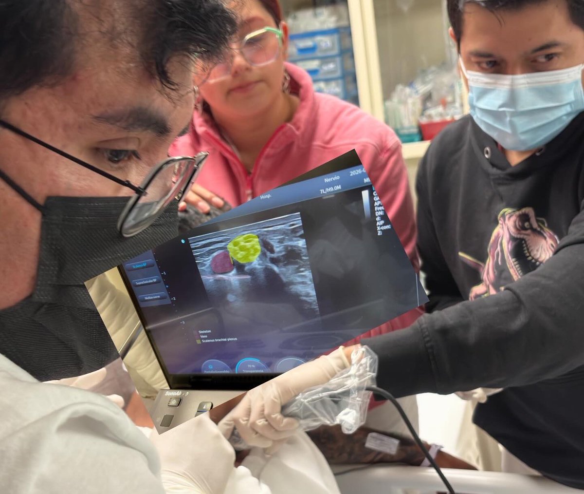 Dr_Dive's tweet photo. La analgesia ecoguiada en Urgencias nos permite:
✅ Facilitar reducciones
✅ Evitar sedación profunda
✅ Disminuir complicaciones
✅ Respetar al paciente
Aquí no es solo técnica. Es #humanizar la atención.
Hoy lo hacemos posible con apoyo de #CHISON #SonoAir, utilizando #SonoNerve para identificar estructuras nerviosas y vasculares de forma más precisa, haciendo el procedimiento más seguro y acortando la curva de aprendizaje.
Orgulloso del trabajo conjunto de los residentes de #Urgencias y Traumatología y Ortopedia, demostrando que la colaboración eleva la calidad.
POCUS no es moda….. es un estándar de atención.
@sonoeye @Berrysophie