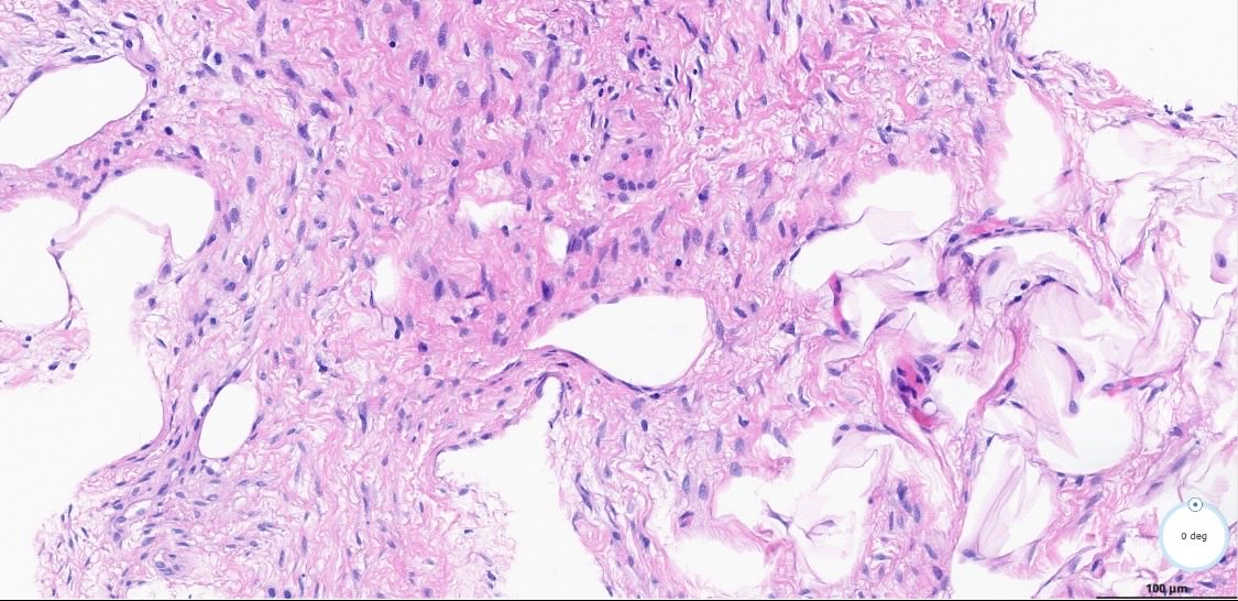 DrBuiPathology's tweet image. #DrBuiBSTCaseCollection 🌻Fat-rich Desmoid Fibromatosis. This case is CTNNB1-mutated, CD34 IHC-negative. A rare finding in a relatively common soft tissue tumor. Not a spindle cell lipoma. @PathX @Pathtwitter ⁦@USFpathology⁩ ⁦@MoffittNews⁩ ⁦@CAPA_comm⁩