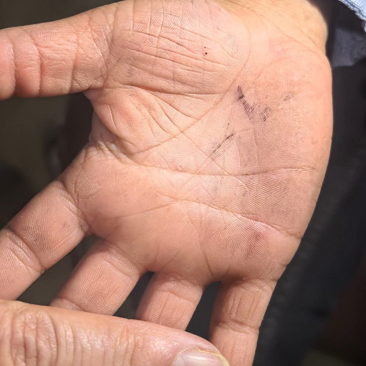 drverver's tweet photo. Enfermedad “mano, pie y boca
Es una infección viral común en niños menores de 5 años. 
Produce fiebre, llagas en la boca y sarpullido en manos y pies. 
Generalmente se resuelve sola en 7 a 10 días. 
Es muy contagiosa: lava las manos con frecuencia y evita compartir objetos. https://t.co/7OqfCSgCdL
