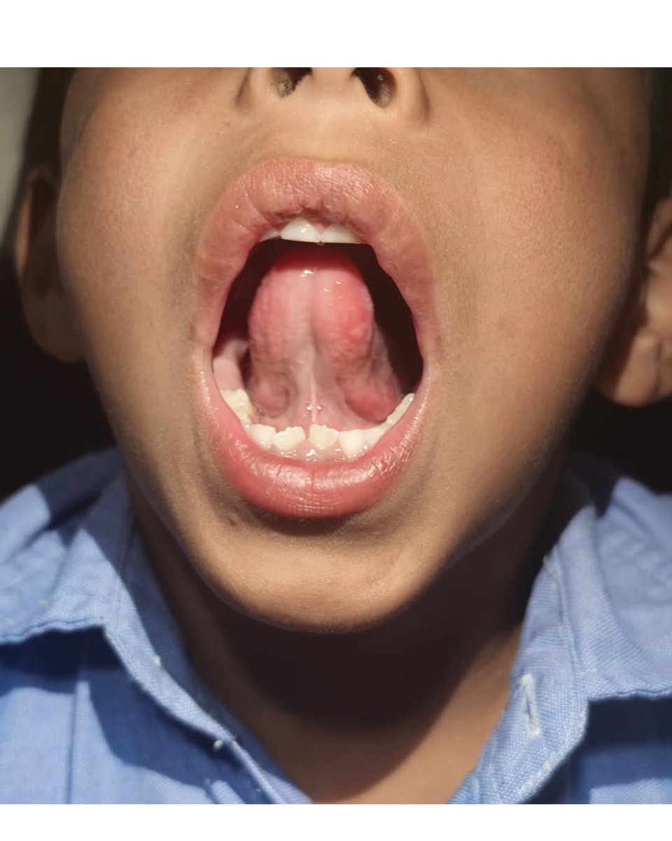 drverver's tweet photo. Enfermedad “mano, pie y boca
Es una infección viral común en niños menores de 5 años. 
Produce fiebre, llagas en la boca y sarpullido en manos y pies. 
Generalmente se resuelve sola en 7 a 10 días. 
Es muy contagiosa: lava las manos con frecuencia y evita compartir objetos. https://t.co/7OqfCSgCdL