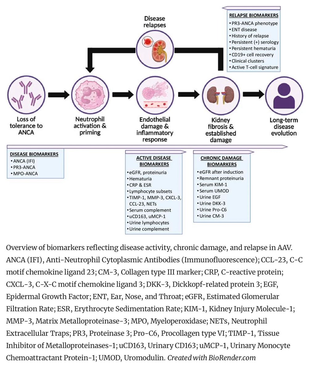 alb_giraldo's tweet photo. #Renal involvement is a key driver of morbidity and mortality in #ANCA-asssociated #vasculitis (AAV). Pathogenesis involves endothelial injury, complement activation, NETosis, and dysregulated immunity, leading to glomerular and tubulointerstitial damage. Distinguishing active inflammation from chronic damage remains challenging, underscoring the need for reliable tools to assess disease activity and predict long-term renal outcomes.

Current evaluation relies on clinical parameters, serum creatinine, proteinuria, and ANCA titers—imperfect surrogates for renal inflammation. Renal biopsy remains the gold standard for assessing activity and chronicity, with histopathological classifications providing prognostic value, though it is invasive and may not capture dynamic injury or repair.

Urinary #biomarkers (from tubular cells, podocytes, and immune pathways) offer promise as non-invasive markers of renal involvement, but studies are limited by small cohorts, heterogeneous definitions, and lack of standardized assays.

Future advances require integrating urinary biomarkers with histopathological and clinical data for precise activity assessment. Large, longitudinal, multicenter studies are needed to validate biomarker panels that differentiate activity from chronic damage, guide treatment, and monitor response. Combining validated urinary biomarkers with biopsy findings could enable precision medicine in AAV, improving prognostication, minimizing toxicity, and enhancing outcomes.

📸 Overview of biomarkers reflecting disease activity, chronic damage, and relapse in AAV.

*From: Mejía-Vilet, J.M., Alba, M.A. & Hinojosa-Azaola, A. The Assessment of Disease Activity and Renal Prognosis in AAV – The Contribution of Urinary Biomarkers and Renal Biopsy. Curr Rheumatol Rep 28, 1 (2026). 
🔗https://t.co/MyMimEl07Z