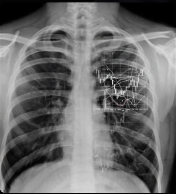 CHARTISKING's tweet photo. Doctor: “Any medical history?”
Me: “Yes… Chart Disorder.”
Symptoms include seeing patterns everywhere, random entries,
and heartbeats syncing with candles. 📉📈
#TraderProblems #ChartAddiction https://t.co/BTLaXsgRE5