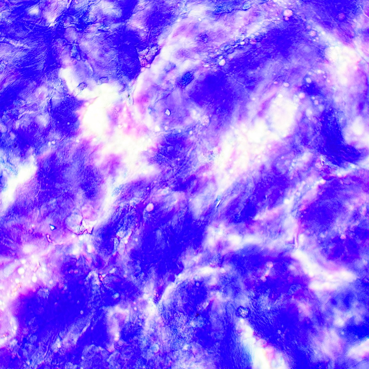 Saroja_DeviG's tweet photo. FNA from a parotid mass revealing a pleomorphic adenoma dominated by abundant matrix material
#PathTwitter #MedTwitter #CytoPath #Cytology #HNPath https://t.co/ESkHVdNtee