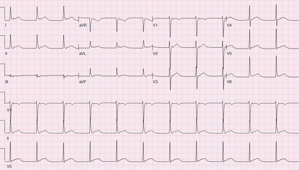 EugenioCingolan's tweet photo. When the #Junction takes over ... 

#AVN #AVJ #JunctionalRhythm #ECG #ST