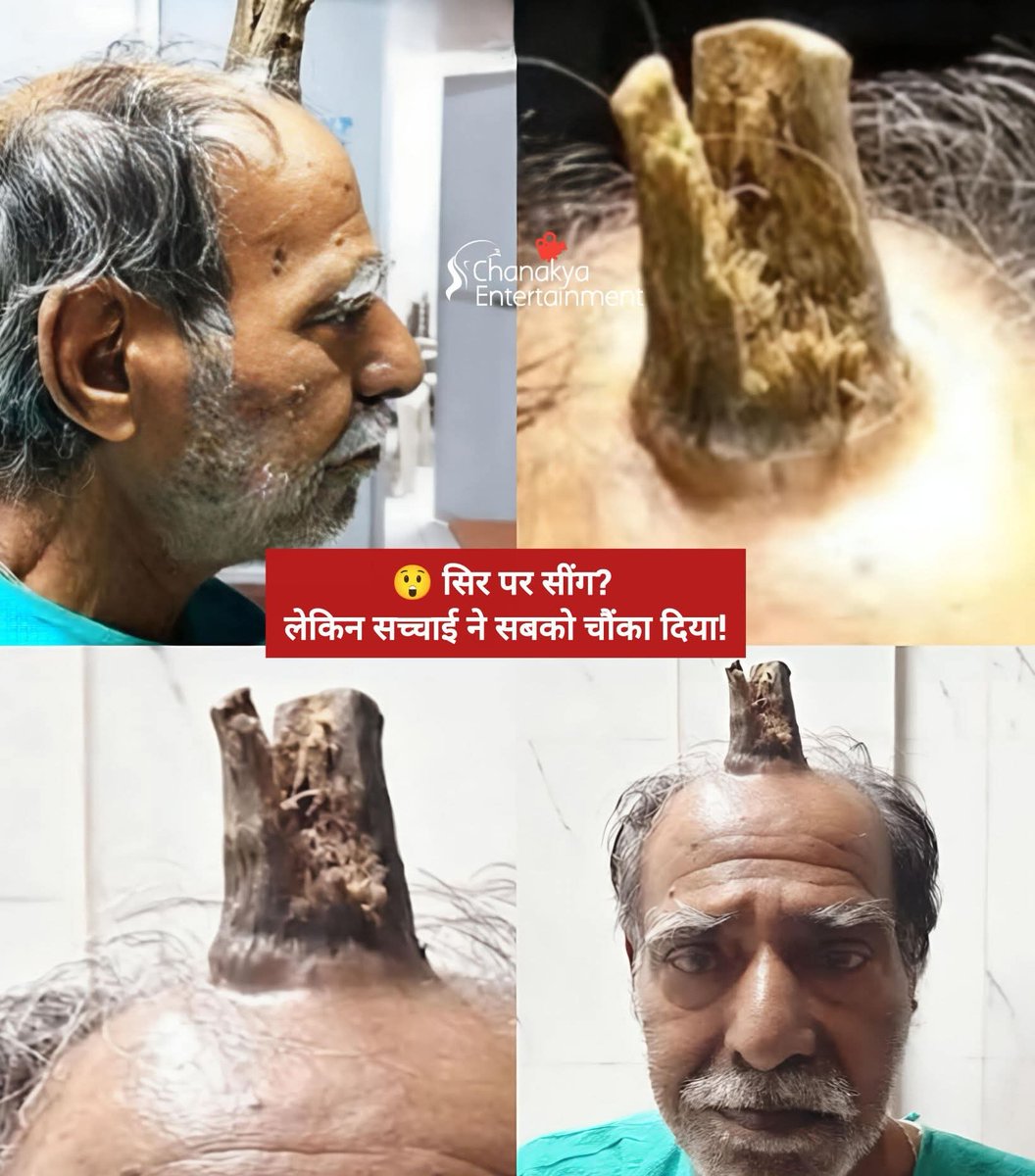 जब एक किसान बना चिकित्सा विज्ञान का चमत्कार

भारत के एक साधारण किसान श्याम लाल की कहानी ने दुनिया को चौंका दिया। उनके सिर के ठीक बीचोंबीच धीरे-धीरे एक ऐसा उभार बढ़ने लगा, जो देखने में किसी जानवर के सींग जैसा था। हैरानी की बात यह थी कि सालों तक इससे उन्हें कोई दर्द या परेशानी नहीं