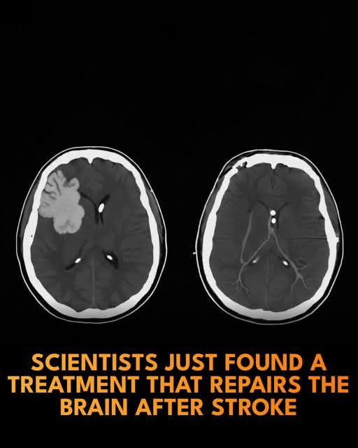 NextScience's tweet photo. 🧠 A new therapy can repair brain damage after stroke.

Scientists at Northwestern University have developed an experimental intravenous (IV) therapy that can help protect and repair the brain after the most common type of stroke. 

In ischemic stroke, a blood clot blocks blood flow to part of the brain. Doctors can now often reopen the blocked vessel, but the sudden return of blood flow can trigger a damaging wave of inflammation and cell death.

 The new treatment uses tiny, dynamic “dancing molecules” called supramolecular therapeutic peptides (STPs). Given through an IV immediately after blood flow is restored, these peptide assemblies were able to cross the blood-brain barrier in mice, concentrate at the injury site, and reduce brain tissue damage, inflammation, and harmful immune activity without detectable side effects.  

This approach builds on earlier work in which similar peptide nanomaterials reversed paralysis and repaired spinal cord tissue in mice after a single injection. For stroke, the researchers adjusted the therapy’s concentration so smaller peptide clusters could safely travel in the bloodstream, slip through the temporarily leaky blood-brain barrier, and then assemble into larger nanofibers inside the brain, where they appear to promote regeneration and calm inflammation. While the current results are from short-term studies in mice, the team hopes the technology could eventually be used alongside standard stroke treatments to limit long-term disability and perhaps be adapted for other brain conditions, such as traumatic brain injury or neurodegenerative diseases. Longer studies will be needed to see whether the therapy improves lasting brain function and recovery.  

References :

Gao, Z., Andrade da Silva, L. H., Li, Z., Chen, F., Smith, C., Lipfert, Z., Martynowicz, R., Arias, E., Muller, W. A., Sullivan, D. P., Stupp, S. I., & Batra, A. (2026). Toward development of a dynamic supramolecular peptide therapy for acute ischemic stroke. *Neurotherapeutics*.  

Northwestern University. (2026, January 17). Scientists develop IV therapy that repairs the brain after stroke. *SciTechDaily*.