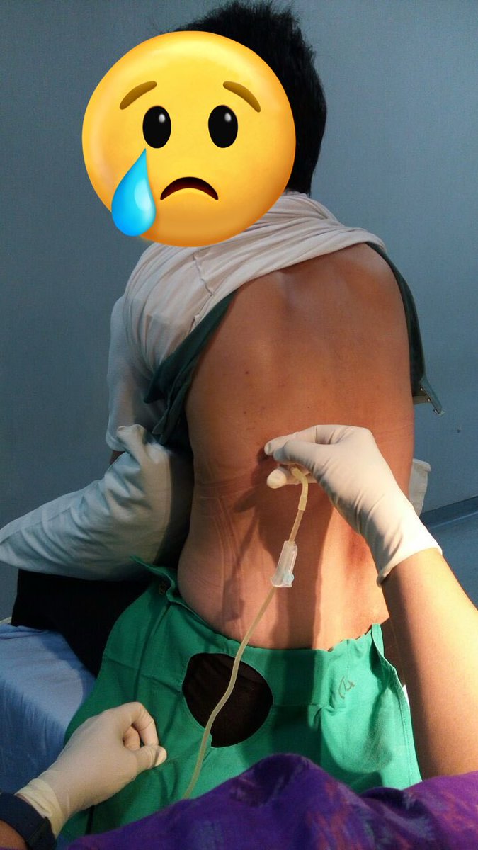 afrkml's tweet image. Kemaren jg dikabari klo kerabatku, masih 20an tahun, parunya keisi cairan.

Ketahuan krn tbtb kolaps, pingsan.
Dibawa ke RS, rupanya parunya sdh penuh cairan. Gaya hidupnya ya merokok.

Penyakit yg dulunya digandrungi lansia, kini udh nyerang yg muda2.
Klo udah gitu mau gimana?🥺