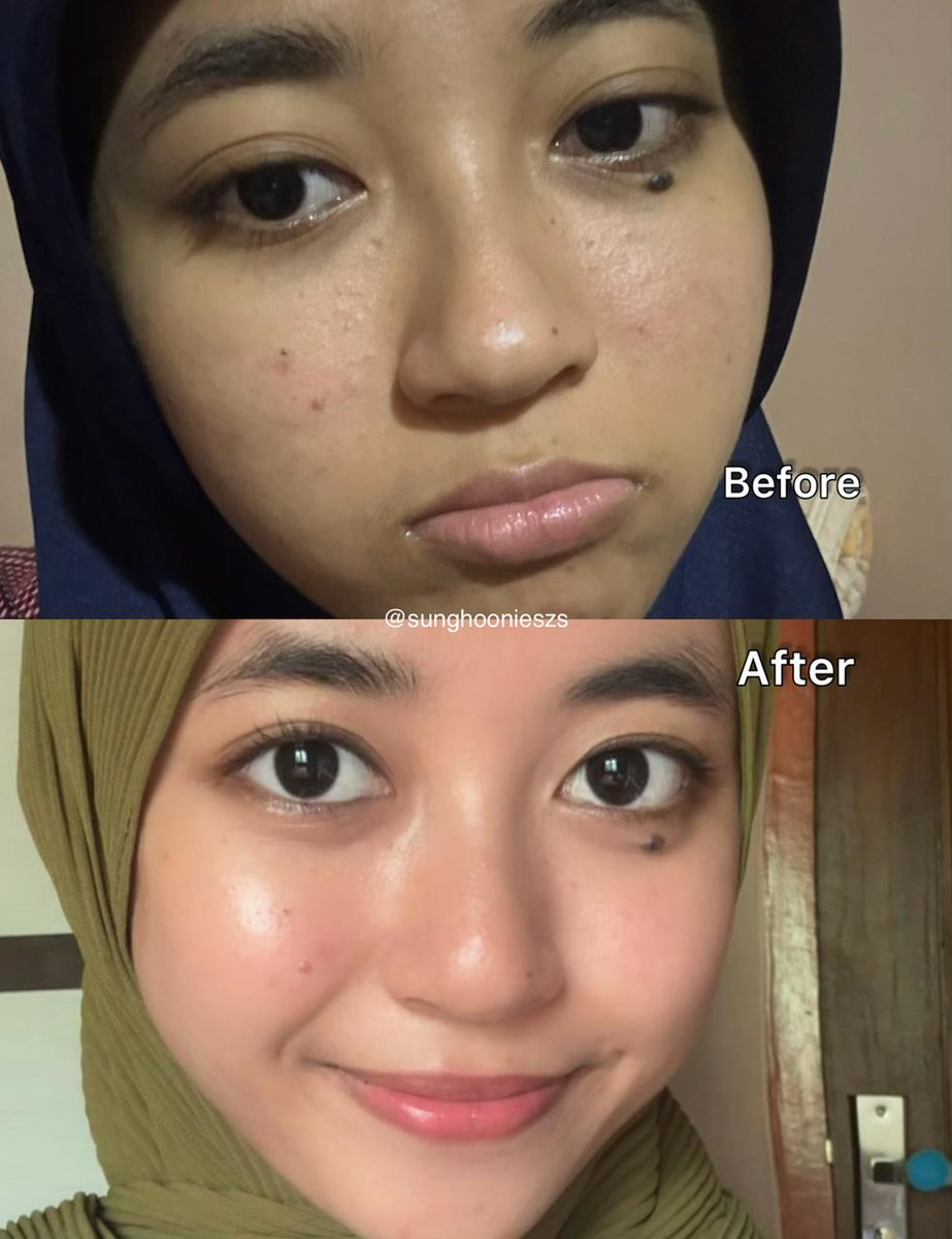 sunghoonieszs's tweet photo. Pernah nggak sih ngerasa kulit tuh udah skincare-an, tapi:
Tekstur masih gradakan, Flek susah banget pudar, Wajah keliatan kusam terus
Padahal udah dirawat, solusinya tuh simpel, 3 langkah basic tapi krusial ✨
Eksfoliasi AHA + Moisturizer + Sunscreen
Aku jelasin pelan-pelan ya https://t.co/9Num6tYcie