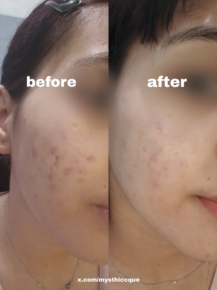 mysthiccque's tweet photo. Pernah ga sih ngerasa kulit kusam, banyak flek hitam, atau teksturnya kasar pdhl udah rajin cuci muka?

​Ternyata kuncinya ada di 3 langkah dasar ini: Eksfoliasi AHA + Moisturizer + Sunscreen! Basic tapi beneran life-changing. Coba sini kumpul, aku jelasin knp ini penting bgt👇✨ https://t.co/Q9eLXNhrRV
