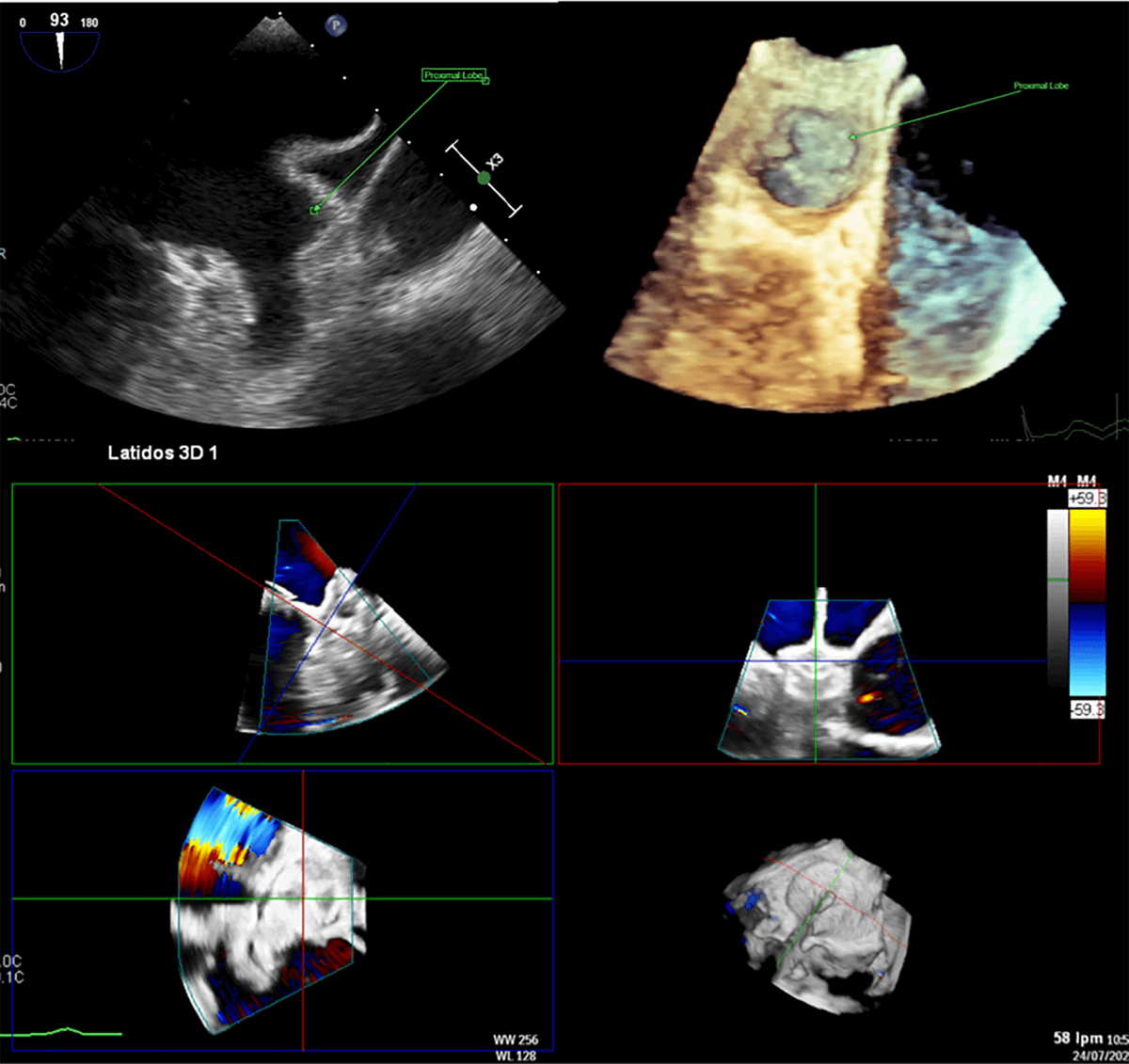 RCMjournal's tweet photo. The latest work from Pere Virgili Health Research Institute @IISPereVirgili by Dr. Mohsen Mohandes and their team is now featured in RCM!
Welcome to read this article 👉: https://t.co/UpBqJaQ9QW
Article Highlights:
💡 Can #LeftAtrialAppendageClosure reshape #StrokePrevention strategies in #AtrialFibrillation when #OralAnticoagulation is contraindicated or insufficient?
This Review synthesises current evidence on #percutaneous #LAAC and provides a practical, step-by-step procedural roadmap, covering patient selection, preprocedural imaging, anatomical sizing, transseptal puncture, device selection and deployment, and intraprocedural assessment. It also highlights expanding indications, advances in #imaging and #device technology, and ongoing challenges in postprocedural #antithrombotic management.
✒️ Authors: Mohsen Mohandes, Leydimar Adel Anmad shihadeh Musa, Alberto Pernigotti @AlbyPernigotti , Mauricio Torres, Cristina Moreno, Roberto Bejarano Arosemena, Francisco Fernández, Jordi Guarinos, José Luis Ferreiro Gutiérrez
🏪 Affiliations: Joan XXIII University Hospital, Pere Virgili Health Research Institute @IISPereVirgili
📖 Don’t miss this citable reference for your future research!
Citation format:
Mohandes M, Shihadeh LA, Pernigotti A, et al. Percutaneous Left Atrial Appendage Closure: Current Evidence and Procedural Insights. Rev. Cardiovasc. Med. 2025, 26(12), 46003.
Welcome to submit your work via our submission link 👉: https://t.co/0im2Ul0zPy
#RCM welcomes review papers, research articles and other types of research in both cardiovascular medicine and cardiovascular disease.
📖 Click here for author guidelines: https://t.co/tKLwCKyDww
#Stroke #StructuralHeart #InterventionalCardiology #DOAC #anticoagulation #RCMPaper