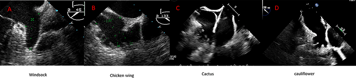 RCMjournal's tweet photo. The latest work from Pere Virgili Health Research Institute @IISPereVirgili by Dr. Mohsen Mohandes and their team is now featured in RCM!
Welcome to read this article 👉: https://t.co/UpBqJaQ9QW
Article Highlights:
💡 Can #LeftAtrialAppendageClosure reshape #StrokePrevention strategies in #AtrialFibrillation when #OralAnticoagulation is contraindicated or insufficient?
This Review synthesises current evidence on #percutaneous #LAAC and provides a practical, step-by-step procedural roadmap, covering patient selection, preprocedural imaging, anatomical sizing, transseptal puncture, device selection and deployment, and intraprocedural assessment. It also highlights expanding indications, advances in #imaging and #device technology, and ongoing challenges in postprocedural #antithrombotic management.
✒️ Authors: Mohsen Mohandes, Leydimar Adel Anmad shihadeh Musa, Alberto Pernigotti @AlbyPernigotti , Mauricio Torres, Cristina Moreno, Roberto Bejarano Arosemena, Francisco Fernández, Jordi Guarinos, José Luis Ferreiro Gutiérrez
🏪 Affiliations: Joan XXIII University Hospital, Pere Virgili Health Research Institute @IISPereVirgili
📖 Don’t miss this citable reference for your future research!
Citation format:
Mohandes M, Shihadeh LA, Pernigotti A, et al. Percutaneous Left Atrial Appendage Closure: Current Evidence and Procedural Insights. Rev. Cardiovasc. Med. 2025, 26(12), 46003.
Welcome to submit your work via our submission link 👉: https://t.co/0im2Ul0zPy
#RCM welcomes review papers, research articles and other types of research in both cardiovascular medicine and cardiovascular disease.
📖 Click here for author guidelines: https://t.co/tKLwCKyDww
#Stroke #StructuralHeart #InterventionalCardiology #DOAC #anticoagulation #RCMPaper