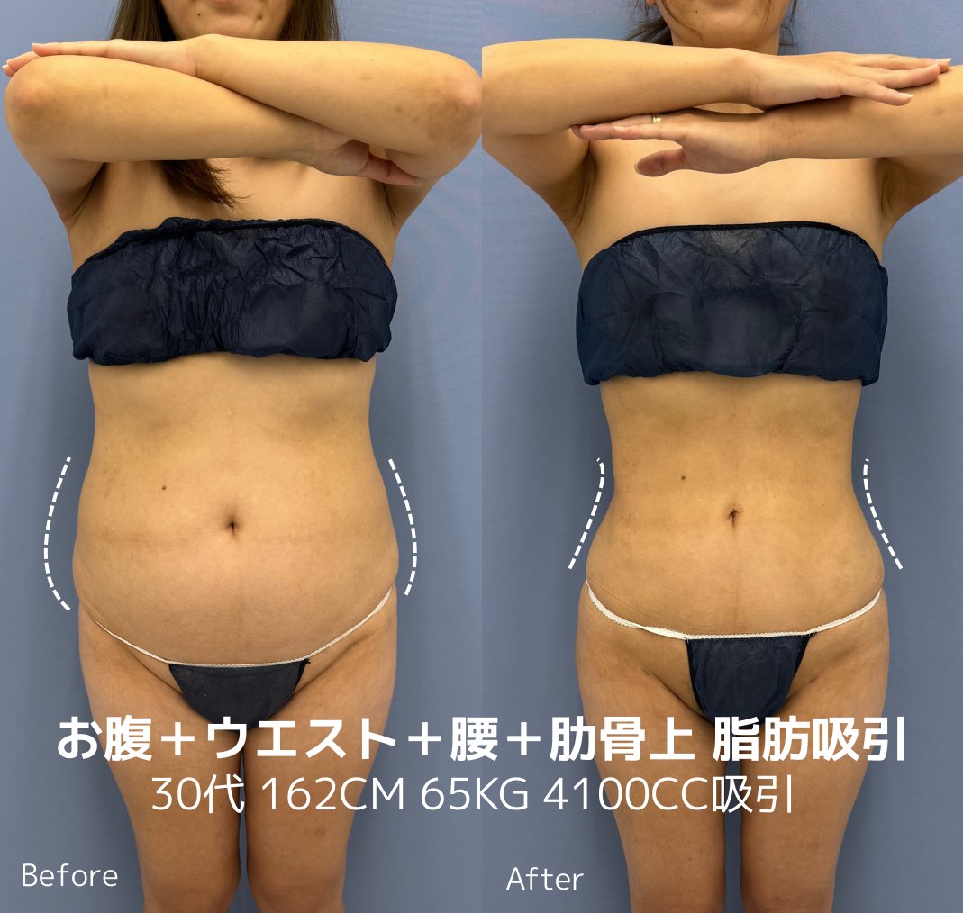 sbc_kuzushima's tweet photo. 正直、「痩せたら可愛くなる」はかなり現実的です。

体の見た目が変わると、印象は一気に変わる。
実際この症例の方も、ぽっこりしていたお腹が脂肪吸引でくびれて、
体だけ見ても別人レベルになっています。

ただし、勘違いしてほしくないのは、 https://t.co/z4TMVWMAJa