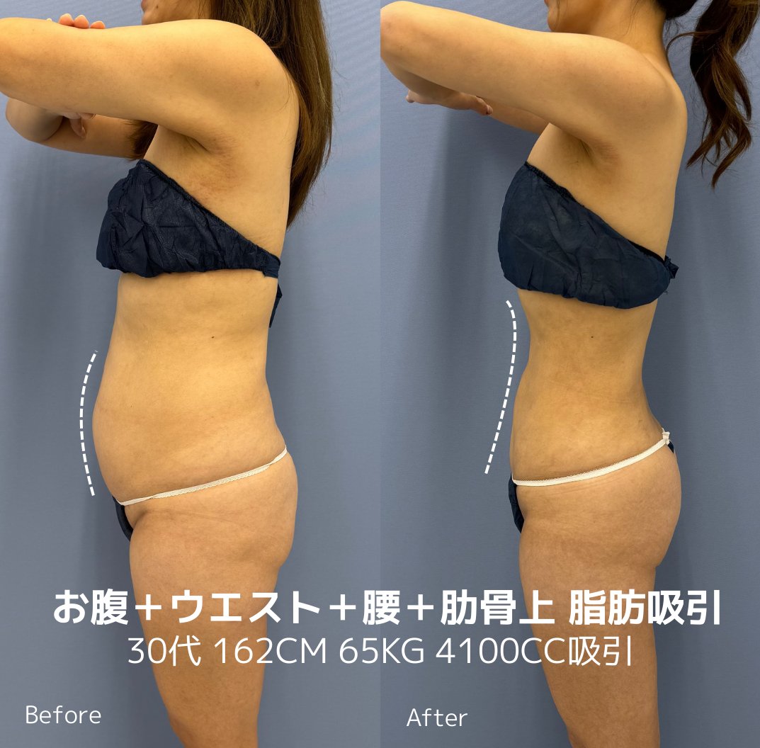 sbc_kuzushima's tweet photo. 正直、「痩せたら可愛くなる」はかなり現実的です。

体の見た目が変わると、印象は一気に変わる。
実際この症例の方も、ぽっこりしていたお腹が脂肪吸引でくびれて、
体だけ見ても別人レベルになっています。

ただし、勘違いしてほしくないのは、 https://t.co/z4TMVWMAJa
