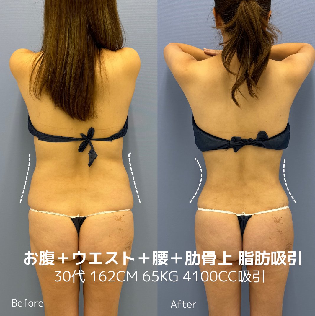 sbc_kuzushima's tweet photo. 正直、「痩せたら可愛くなる」はかなり現実的です。

体の見た目が変わると、印象は一気に変わる。
実際この症例の方も、ぽっこりしていたお腹が脂肪吸引でくびれて、
体だけ見ても別人レベルになっています。

ただし、勘違いしてほしくないのは、 https://t.co/z4TMVWMAJa