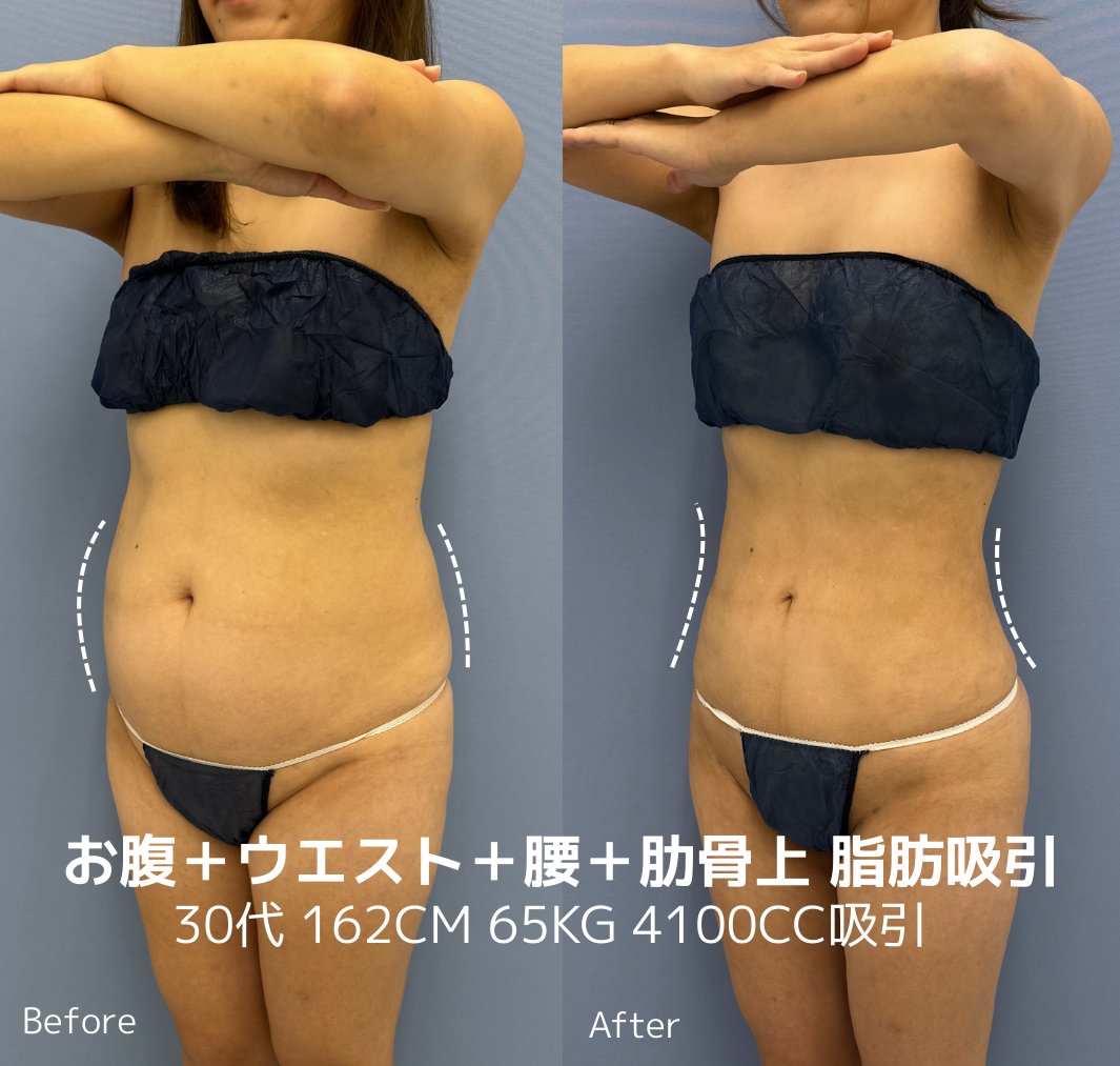 sbc_kuzushima's tweet photo. 正直、「痩せたら可愛くなる」はかなり現実的です。

体の見た目が変わると、印象は一気に変わる。
実際この症例の方も、ぽっこりしていたお腹が脂肪吸引でくびれて、
体だけ見ても別人レベルになっています。

ただし、勘違いしてほしくないのは、 https://t.co/z4TMVWMAJa
