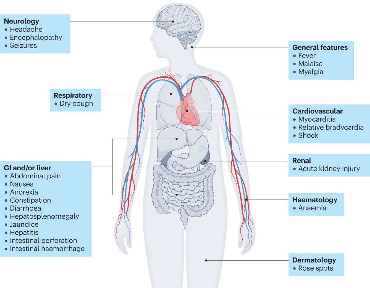 DraWataru's tweet photo. Typhoid fever | Nature Reviews Disease Primers

(https://t.co/7t2ROT1qRE) https://t.co/aoyNwZwcFH