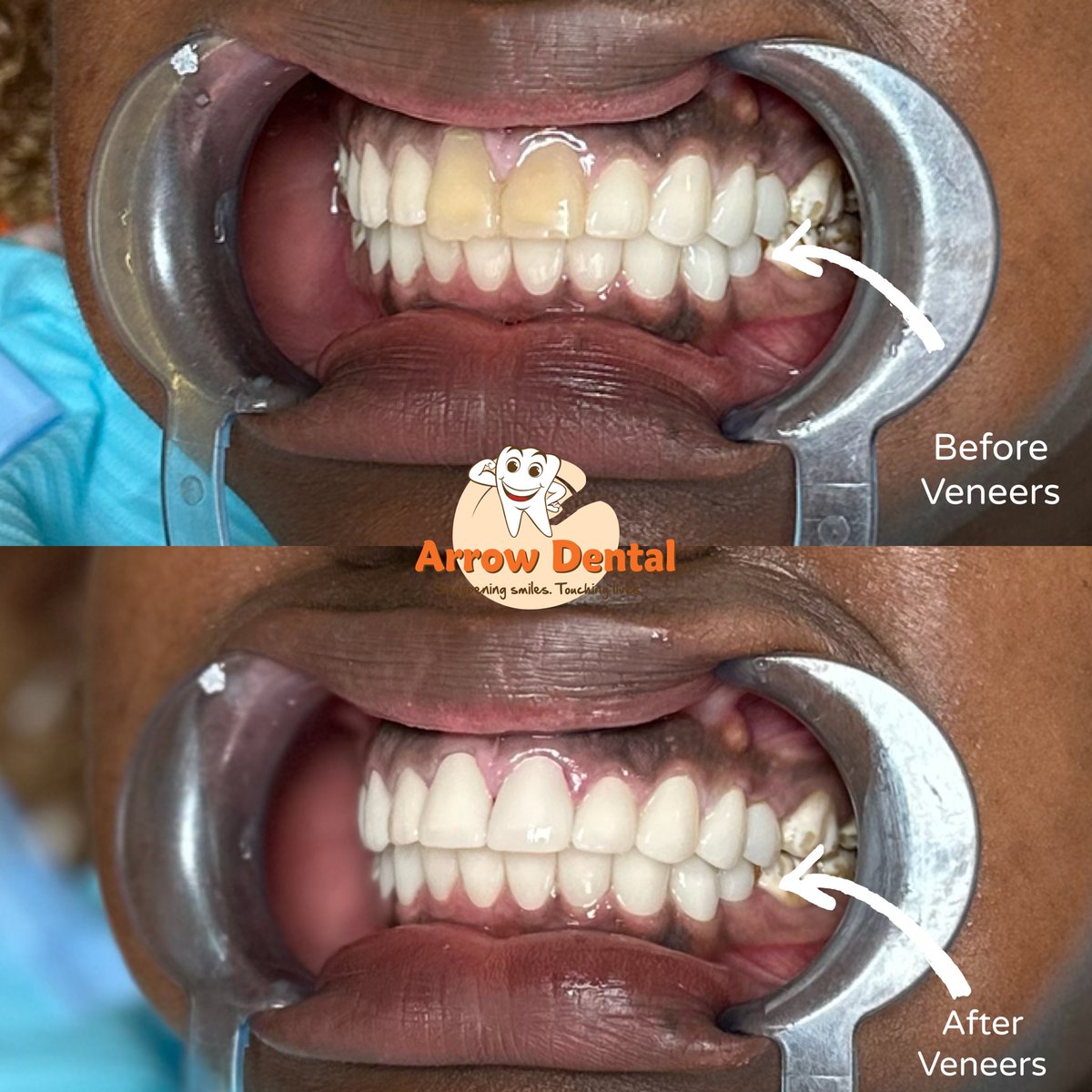 Arrow_Dental's tweet image. Two teeth.
That’s all it took to shift the entire smile 🤩

Anterior teeth wrapped ✔️
Posterior teeth next ✔️

Details matter.
And at @Arrow_Dental , we master them 🏹

📲 0769899516 | 0740187579