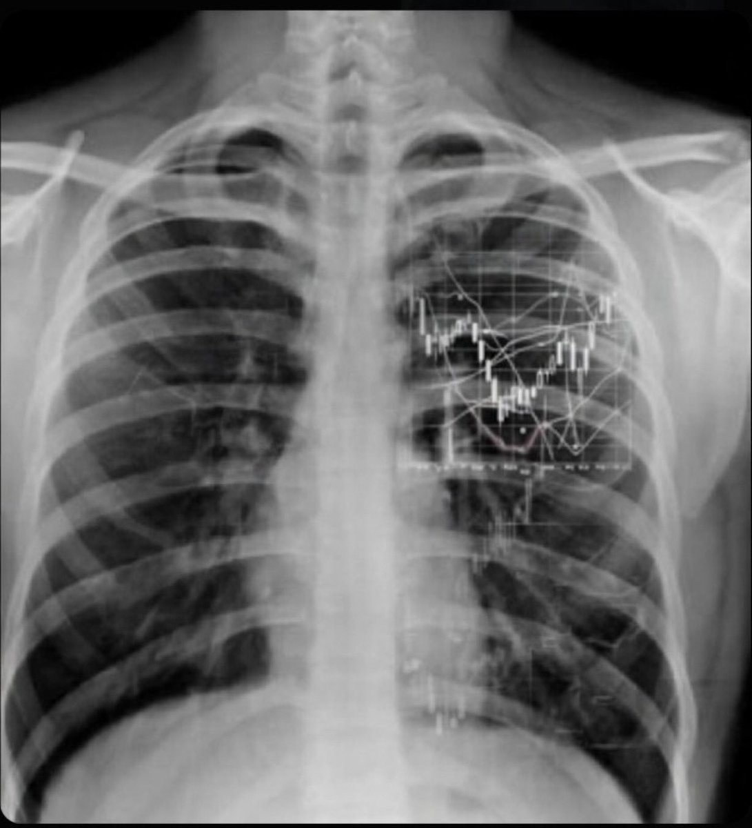 Diagnosed with Chronic Chart Disease