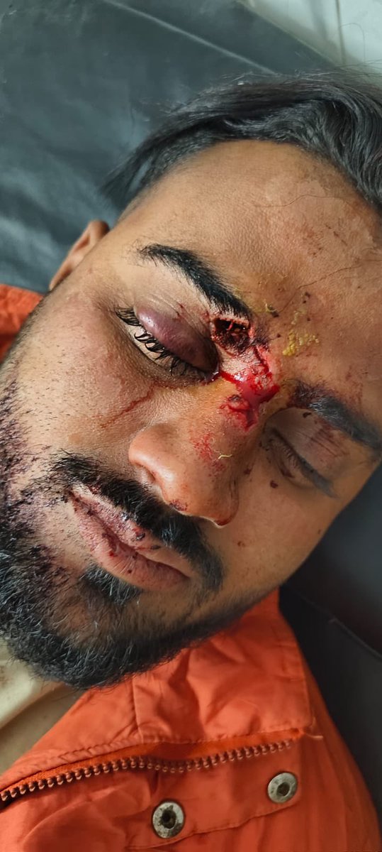 बागपत में अपराध चरम सीमा पर है <a href="/baghpatpolice/">Baghpat Police</a> इतनी निकम्मी है कि (21/11/2025 , FIR-0701/25 ) FIR दर्ज है लेकिन दरोगा मनजीत जी (IO) से 2 माह में कोई गिरफ्तारी नहीं की विक्टिम आबिद के आखों के 4 ऑपरेशन होने के बाद भी आखो से दिखाई नहीं दे रहा और लगातार विपक्ष धमकी दे रहा है