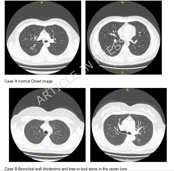 Interasma's tweet image. Abnormalities on chest high-resolution #computed #tomography in patients with #cough-#variant #asthma. Open Access. interasma.org/2026/01/20/abn…