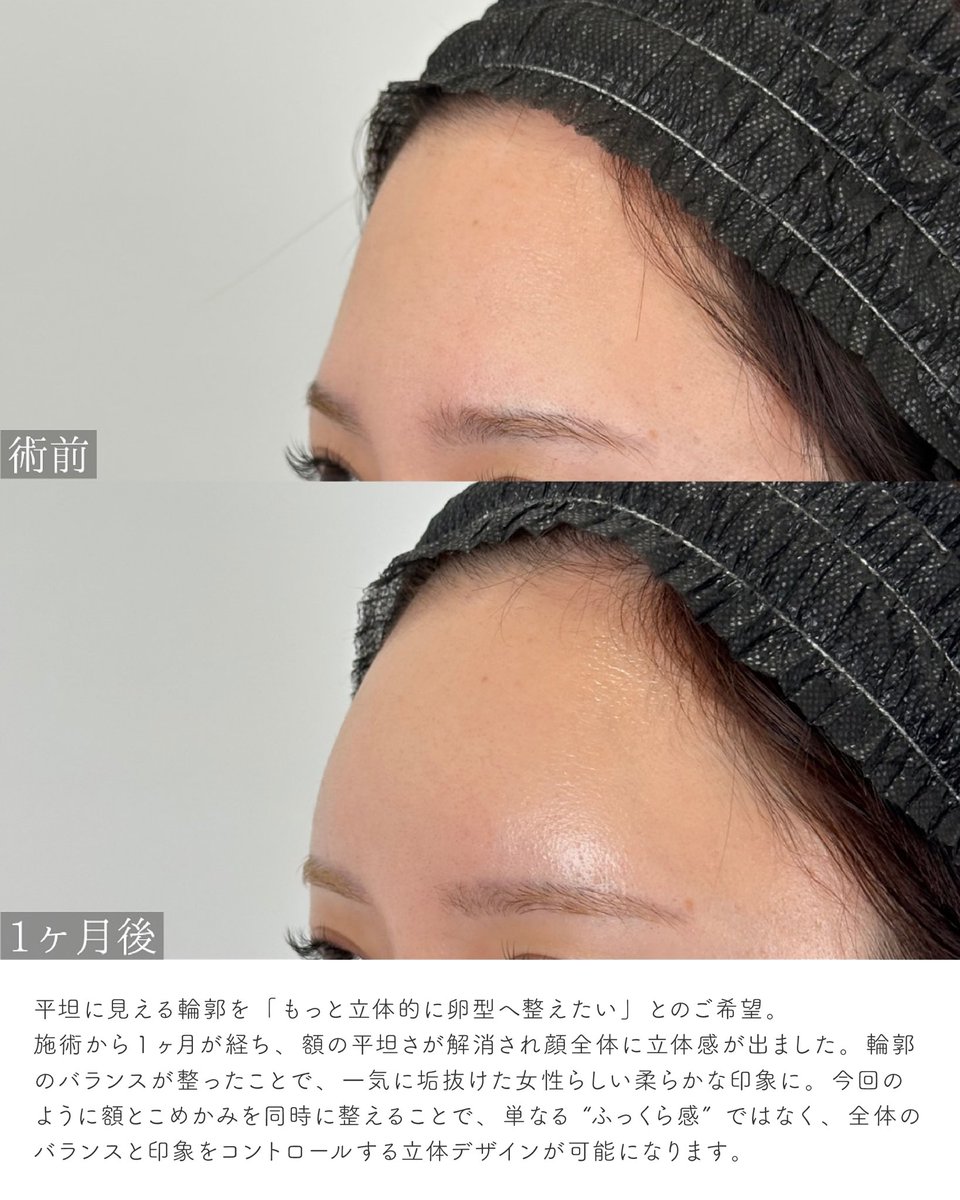dr_asano_tomo's tweet photo. 【額・ホホは脂肪注入の相性が良い部位】

額は脂肪の定着が比較的安定しやすく、しこりのリスクも低い場所。ほうれい線のように“定着が難しい部位”とは対照的です。

❌ヒアルロン酸で丸みを作ろうとすると大量に必要になり、コスト面の負担も大きくなりがち。
✅脂肪注入なら、基本的には1度である程度満足のいく定着が期待できる。

脂肪吸引で採取した脂肪を活かしたいという方が脂肪注入を選ぶ理由はここにあり、額に関しては迷わず勧められるケースが多いです。

これらは全て1度の脂肪注入による額の変化です。横顔が一段と美しく見えます。
ダウンタイムも少なく、結果も満足していただけました👶