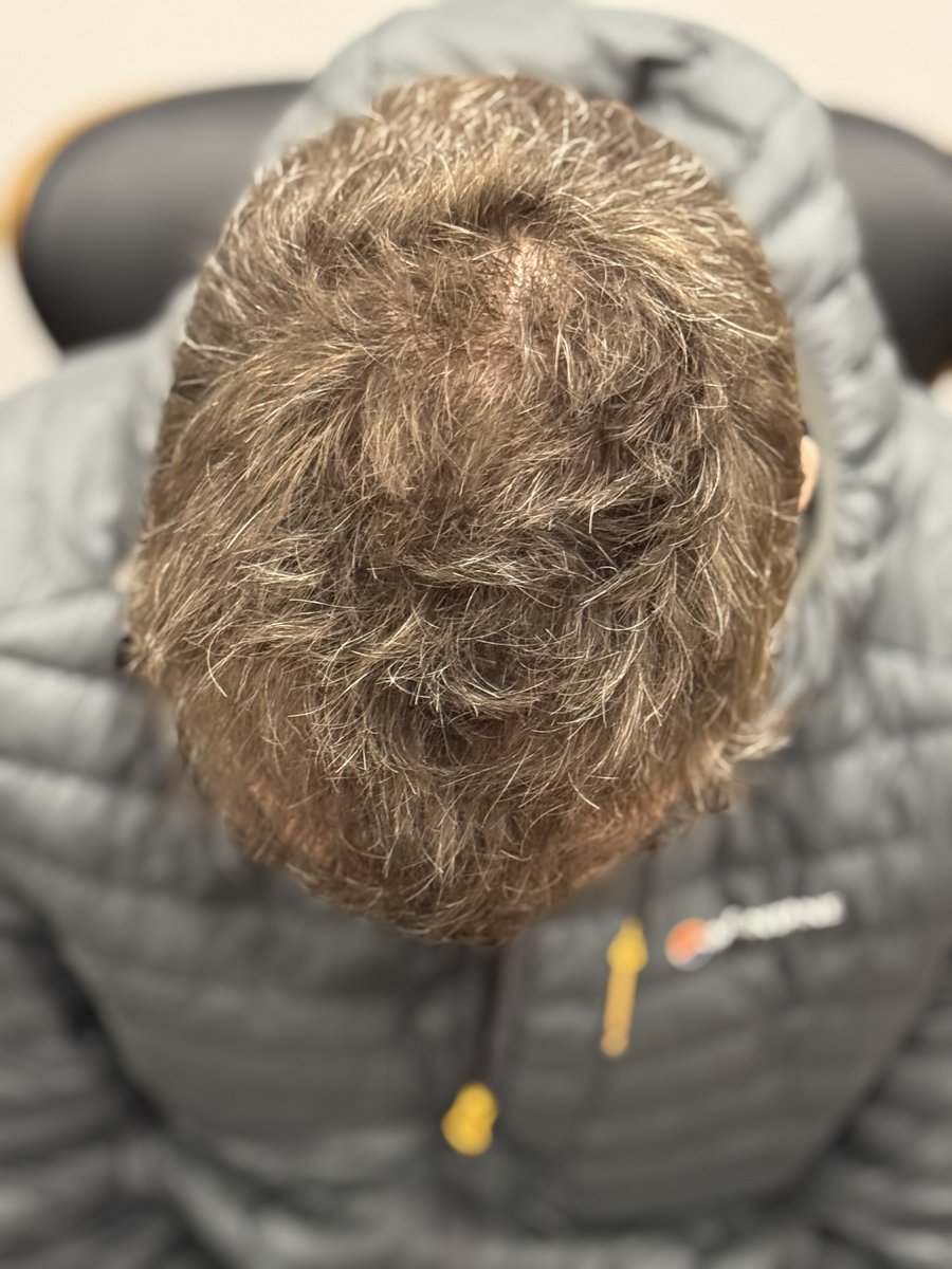 MerchantCityMed's tweet photo. From pre-op to 12months post-op 🔥 #fue #scotland #transplant #hairloss #doctor https://t.co/YFvRFVNtAn