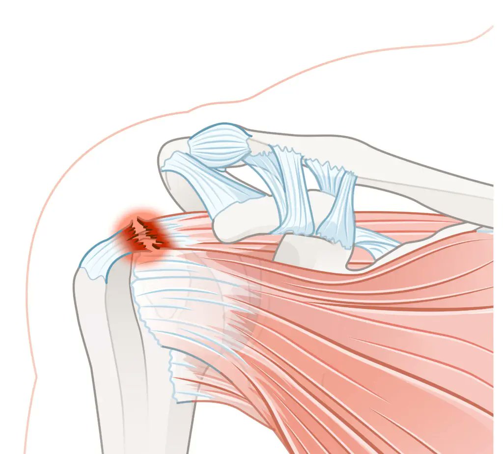 The lateral jobe test evaluates for rotator cuff injuries. The patient’s shoulder is abducted to 90° in the coronal plane, elbows flexed to 90°, and shoulders internally rotated so the fingers point inferiorly. The examiner applies an inferiorly directed force at the distal arm