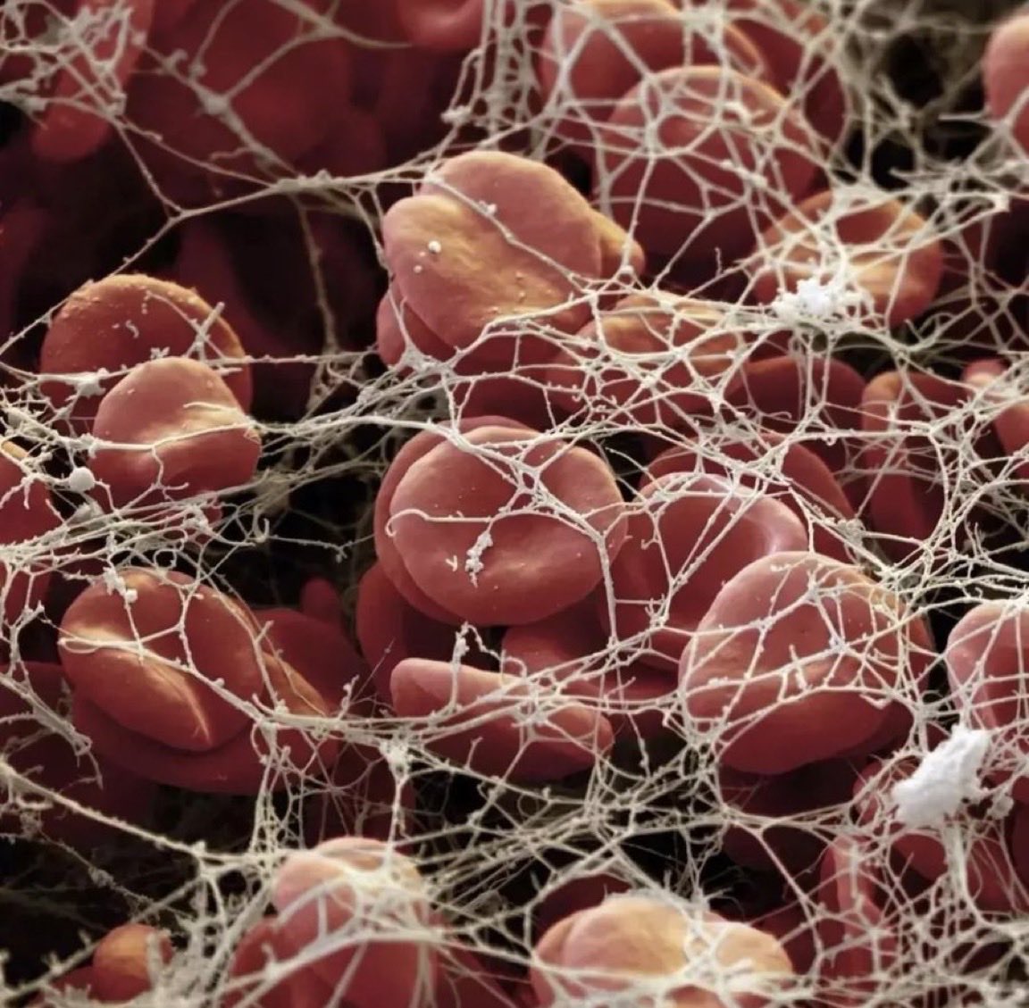 This is a super helpful visual of a blood clot, red blood cells (erythrocytes) trapped in a mesh of fibrin threads. Fibrin is a protein formed after injury to blood vessels. I tell all my friends and family of elderly patients to look out for this condition in prolonged rest.