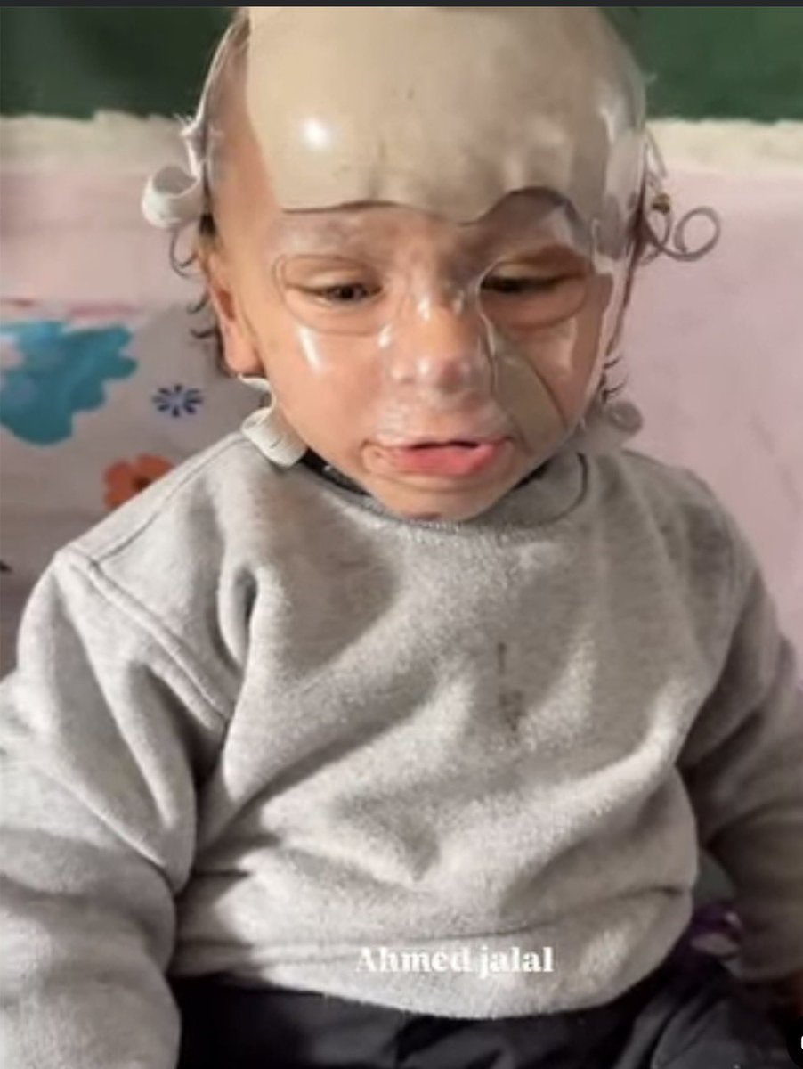 Emeliarjl's tweet image. The child Mohammed is a prisoner of a plastic mask and a savage tissue that has disfigured his angelic face and small body, burning the hearts of all who know and love him. Mohammed is enduring a harsh suffering far beyond his years, while his family fights with everything they…