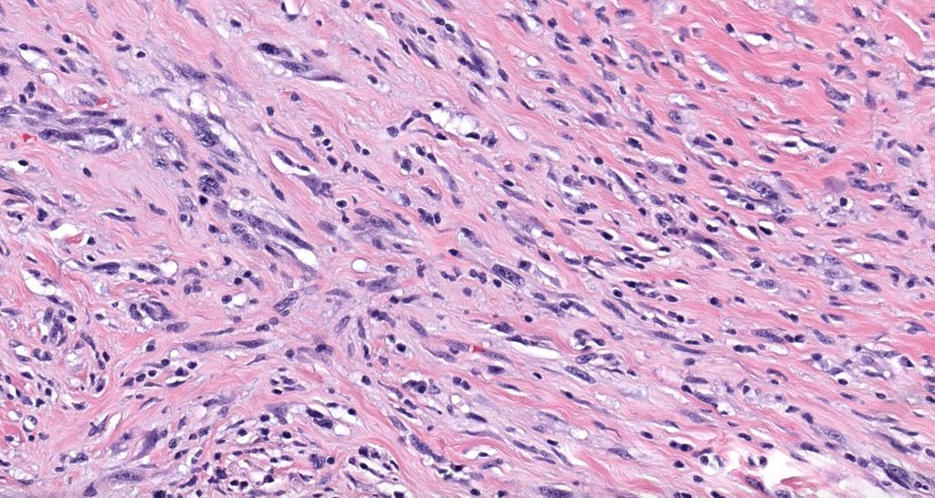 80 yo man with slowly growing firm white scar-like plaque on scalp.
Answer ✅  youtu.be/pdQk2vx1Dtw?si…
WSI digital slide: kikoxp.com/posts/5125. 
#BSTpath #pathology #pathologists #pathTwitter #dermpath #dermatology #dermatologia #dermtwitter