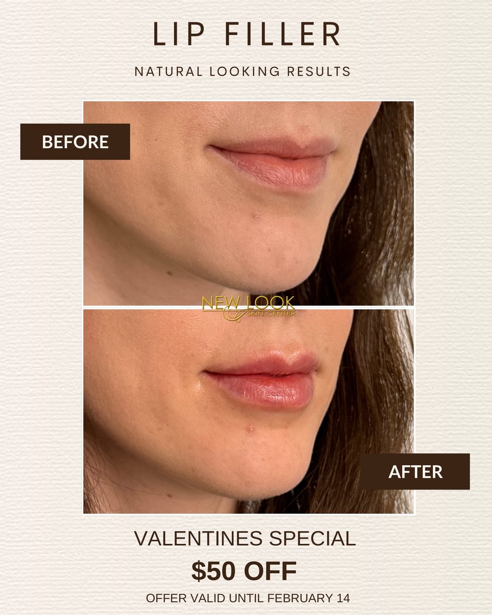 NewLookSkin's tweet photo. Your lips, just better 💕
$50 OFF lip filler until Valentine’s Day!
.
.
.
#lipfillers #lipfillerbeforeandafter #kissablelips #botox #medspa https://t.co/A0faa5JtIR