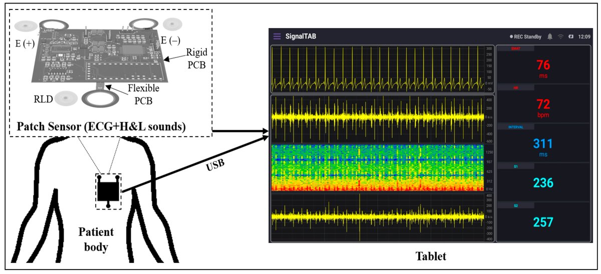 Biosensors_MDPI's tweet image. 📣Call for Reading:

#Article
Tablet-Based Wearable Patch Sensor Design for Continuous Cardiovascular System Monitoring in Postoperative Settings

by Nourelhuda Mohamed, et al.
mdpi.com/2079-6374/13/6…

#tablet #PatchSensor #Cardiovascular #wearable
#biosensors #mdpi #openaccess