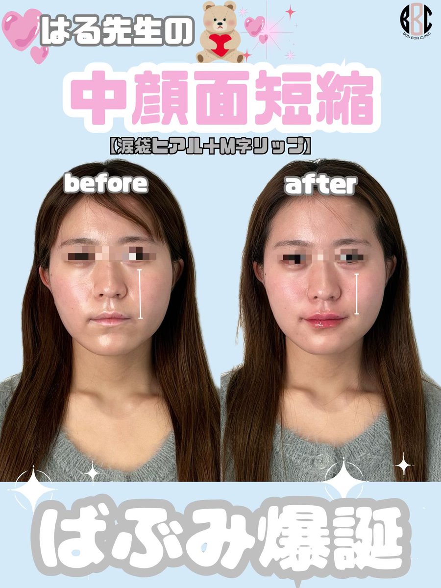 BONBONCLINIC's tweet photo. ❤️‍🔥今人気の施術❤️‍🔥

唇ヒアル➕口角ボトックス➕人中ボトックス➕涙袋ヒアル🎀✨
M字リップで、ちゅるんとした口元に💖
涙袋ヒアルも一緒にすることで中顔面短縮効果あり🫶🏻💗💞

糸リフト・ボトックス・カベリンも
お得なクーポン🎁LINE限定で配布中🌈

📲今すぐチェックしてねっ💌

☎️03-6263-8261
LINE▶️【@bonbonclinic】で検索🔍

#銀座美容 #bonbonclinic #糸リフト #ヒアルロン酸 #ボトックス