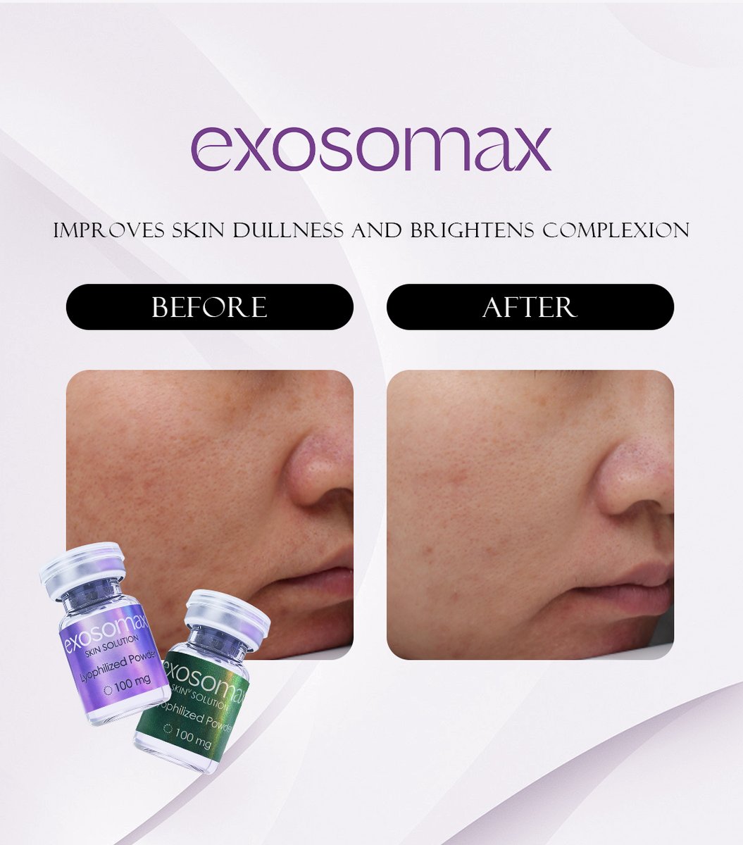 EXOSOMAX's tweet photo. Tired of dull, uneven skin tone? 

See the difference after just 2 sessions of our exosome skincare product. 

This client’s skin appears visibly calmer with reduced redness—plus a radiant, more even-looking complexion!

#ExosomeSkincare #RadiantSkinGoals #ExosomaxGlow https://t.co/68RODs3mNe
