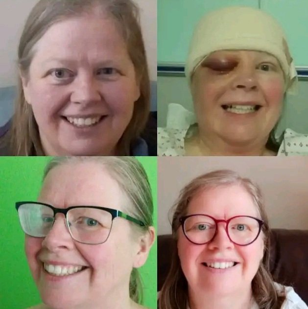 lanepacer's tweet photo. 6 years today since first surgery for intra osseous SOM. Nearly 4 since the second surgery. My manager said in 2023 I couldn't do my job any more. Took 2 years to be retired on ill health. Grateful thanks @SkullBaseLeeds https://t.co/JlJwcxA5gU