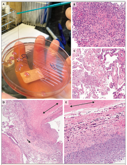AliSMV7's tweet image. Case 2-2026: A 63-Year-Old Man with Pulmonary Nodules, Liver Mass, and Vision Loss

DOI: 10.1056/NEJMcpc2402495