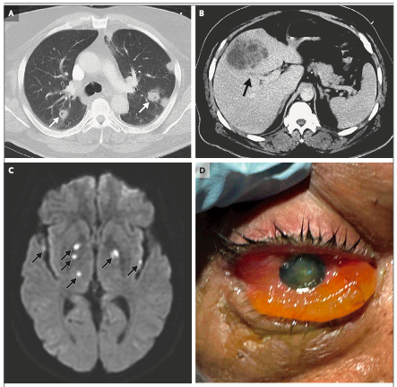 AliSMV7's tweet image. Case 2-2026: A 63-Year-Old Man with Pulmonary Nodules, Liver Mass, and Vision Loss

DOI: 10.1056/NEJMcpc2402495