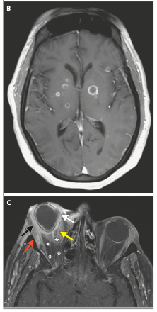 AliSMV7's tweet image. Case 2-2026: A 63-Year-Old Man with Pulmonary Nodules, Liver Mass, and Vision Loss

DOI: 10.1056/NEJMcpc2402495