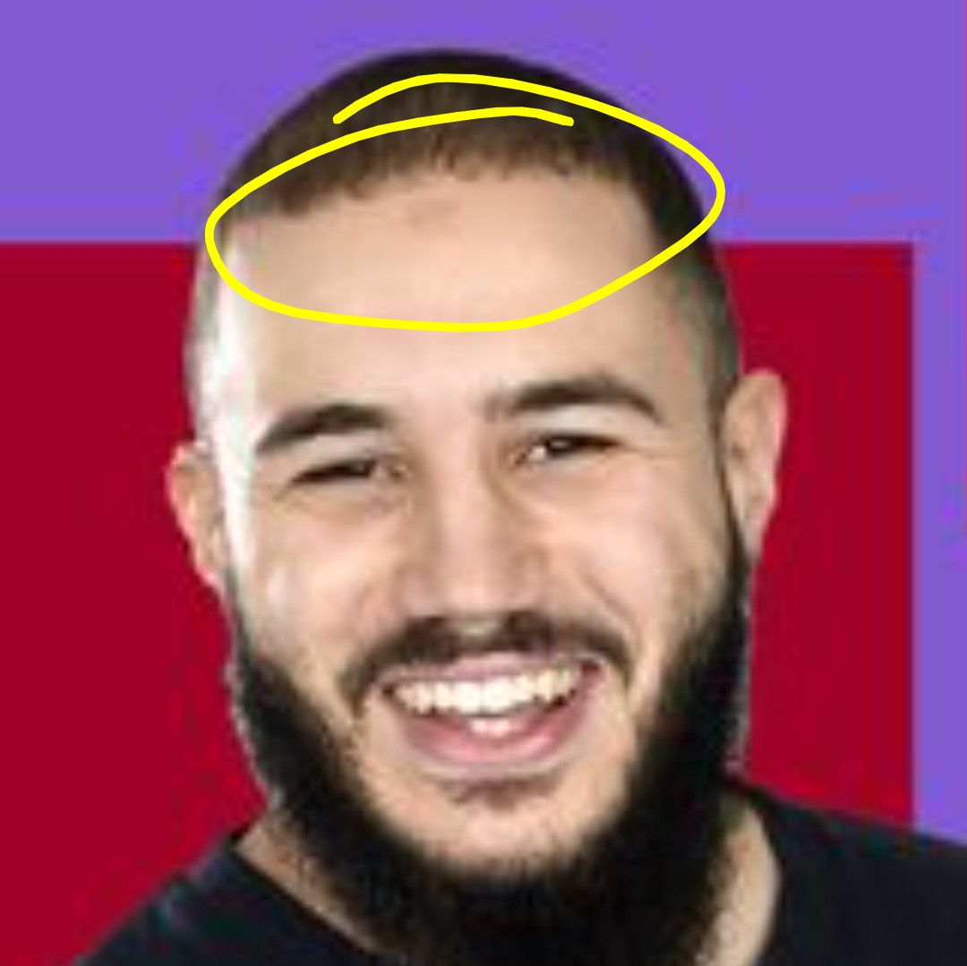 gauchecaca's tweet image. Hello, France Inter.
Pourriez vous me rassurer au sujet de votre fameux humoriste Merwane Benlazar?
Quelle est cette marque sur son front?
Se serait-il cogné?
Aurait-il été piqué par une araignée?
Est-ce une tache de naissance?
Dites moi, car de méchants islamophobes racistes et…