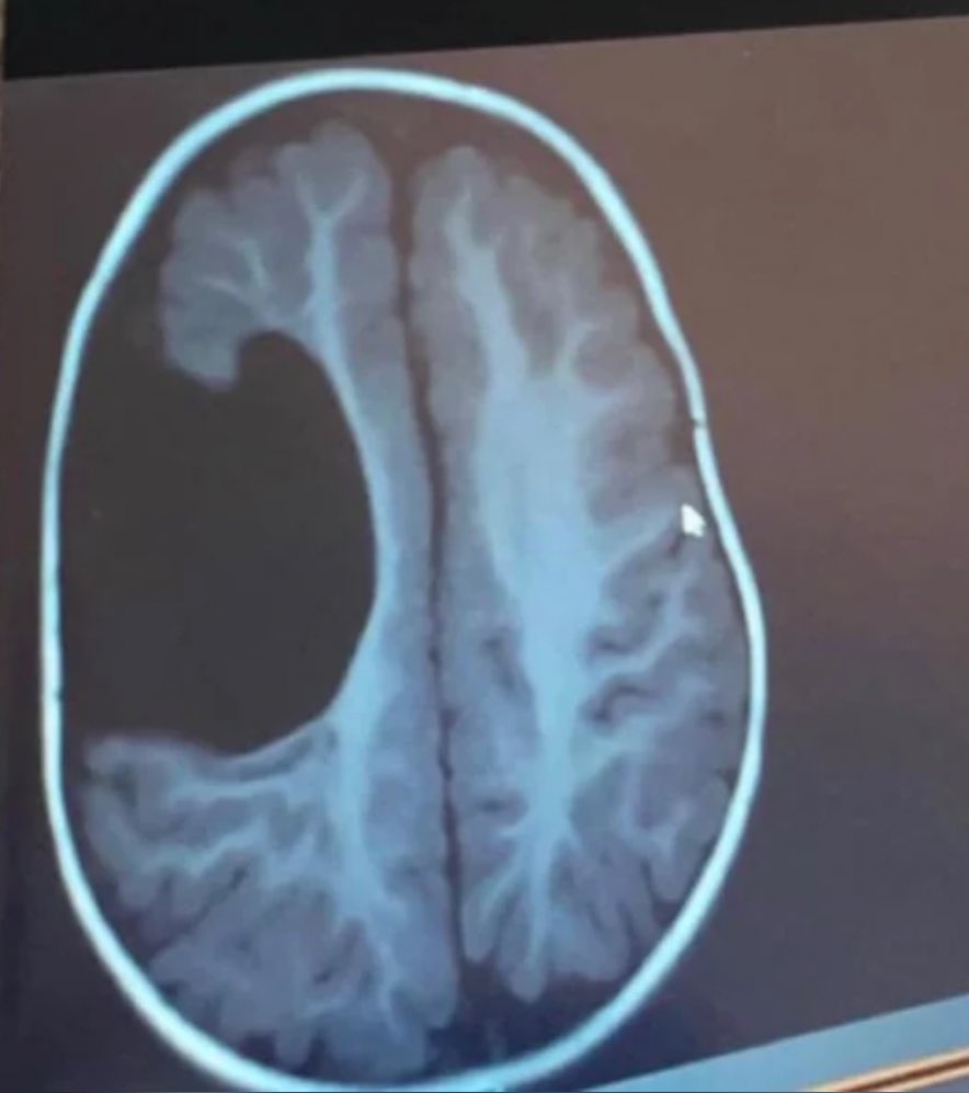 😱 En 1984, à Londres, une femme a commencé à entendre une voix dans sa tête lui disant qu'elle avait une tumeur au cerveau.

Malgré l'absence d'autres symptômes, elle passe des examens et les médecins ont effectivement découvert une tumeur à l'endroit indiqué par la voix.

La