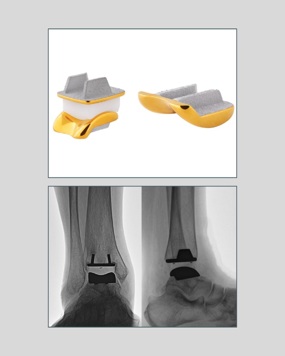 BoneJointJ's tweet image. The TARIC total ankle arthroplasty (TAA) implant improved patient-reported clinical outcomes similarly to the outcomes reported in previous studies with other modern TAA implants.

#AnkleArthroplasty #Arthroplasty #BJJ

ow.ly/vYSs50XW1BS