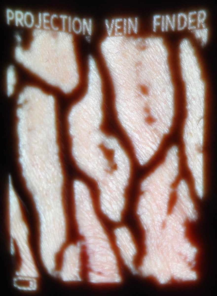 nextveinus's tweet photo. Same Veins, Different Ways to See Them #nextvein #health #healthcare #veins https://t.co/2QaIQh47Zq