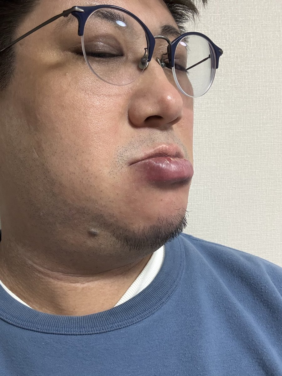 kokujind's tweet photo. なんか起きたら下唇と顎が腫れてる、痺れがあって喋りづらい
かかりつけの歯医者に電話したら耳鼻科？って言われたから耳鼻科来てる。
なにこれ？
怖い、、、 https://t.co/aiGvYg50lK