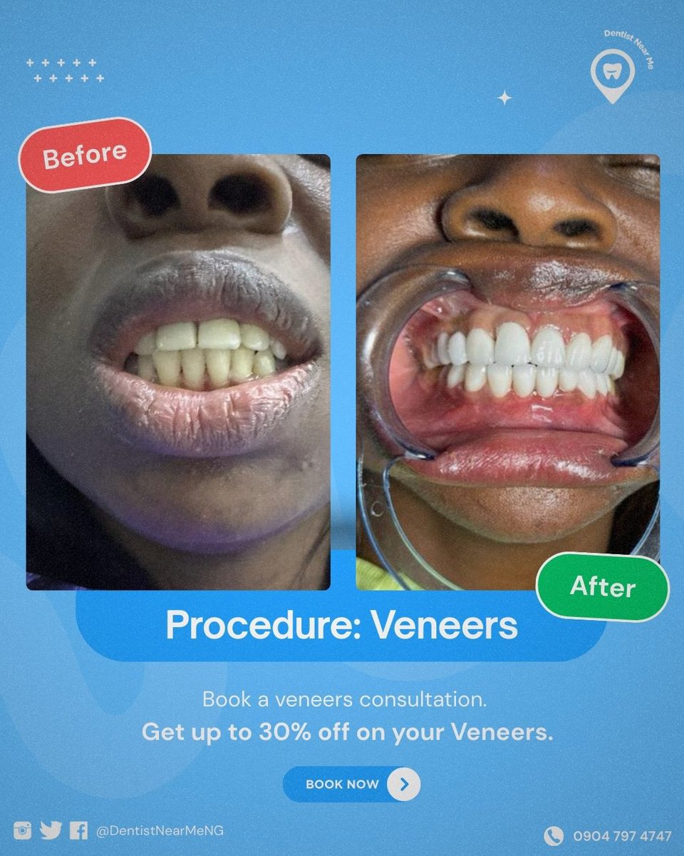 DentistNearMeNG's tweet photo. Transform Your Smile with Our Premium Veneers 

Number of teeth: 20 (10 TOP, 10 BOTTOM) 
PROMO PRICE: N1,500,000 ($1000) was N2,000,000 ($1,333)

- Perfectly customized to fit your facial structure. https://t.co/DsnUEM9cZz