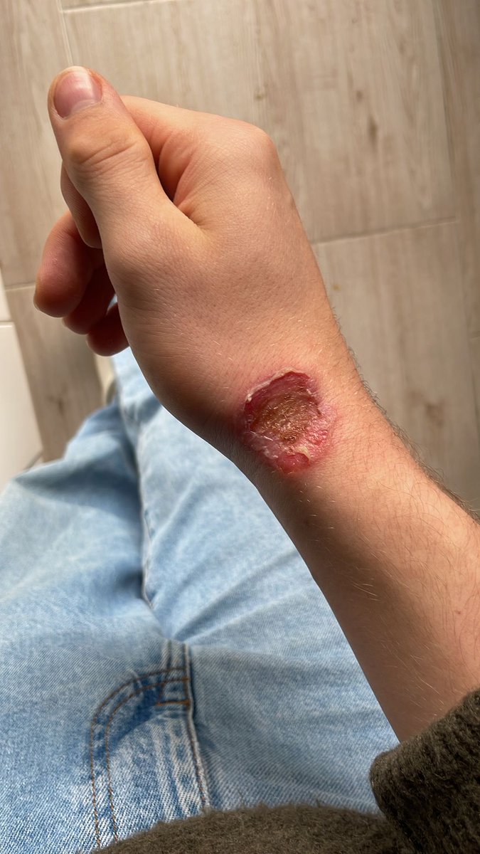 lijoscha's tweet image. If you get staph or ringworm from fighting, as always in life, you need to act fast. I learned that the hard way.

Over 2 years ago, I got Staph (Staphylococcus), a common skin infection among fighters that can cause serious damage, killing over 1.1 million people yearly around…