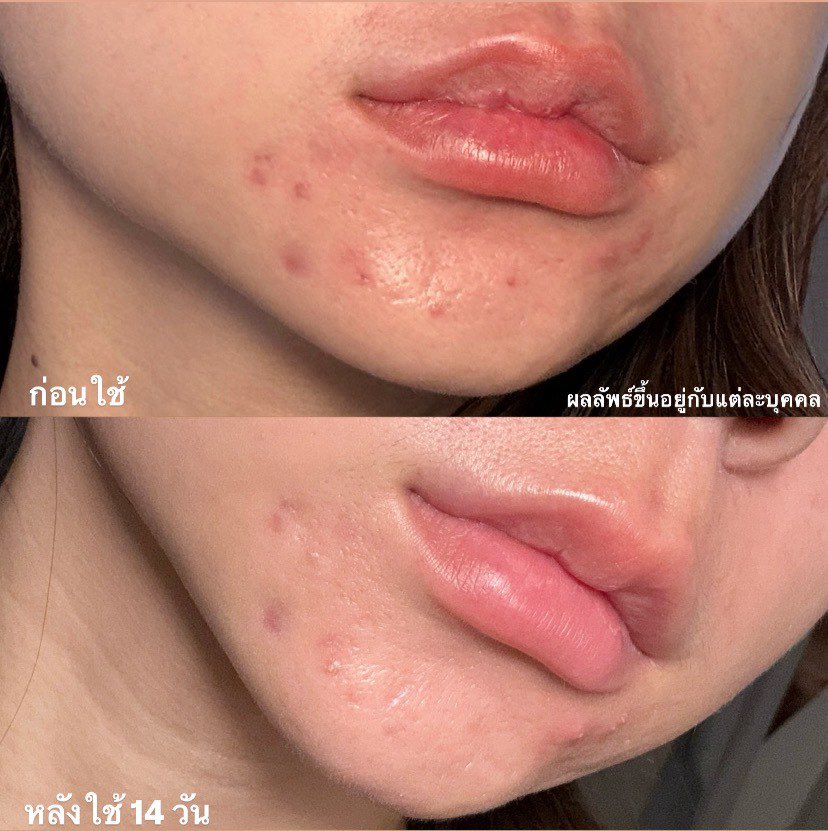 ชอบแบรนด์ที่รู้ว่าตัวเองเก่งอะไรแล้วทำให้มันดีขึ้น จากใจคนเป็นสิวเมคอัพ แต่งหน้าทีไรสิวบุกทุกที แถมยังทิ้งรอยสิวไว้อีก แต่ Eucerin DermoPure Clinical  = แก้สิว+รอยสิวในตัวเดียว ไม่ต้องใช้หลายตัว จบเลยสกินแคร์คนเป็นสิว คือดี active เห็นผล