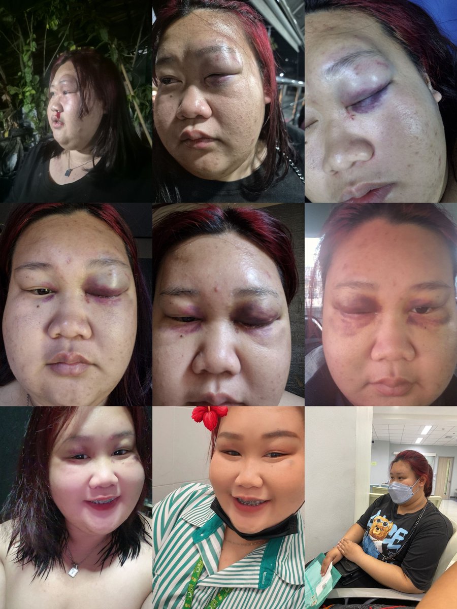 พี่ๆค่ะช่วยหนูหน่อยได้ไหมค่ะหนูไม่ได้รับความยุติธรรมเลยค่ะ หนูโดนลูกติดของน้าชายหนูทำร้าย(ลูกติดมากับแฟนของน้าชาย)เหตุการณ์เกิดขึ้นวันที่4ม.ค.2569เวลา21:30น.

พอเกิดเรื่องได้โทรแจ้งความตอนนั้นหนูได้ใส่เเว่น ผู้ก่อเหตุได้ต่อยบริเวณตาข้างซ้าย