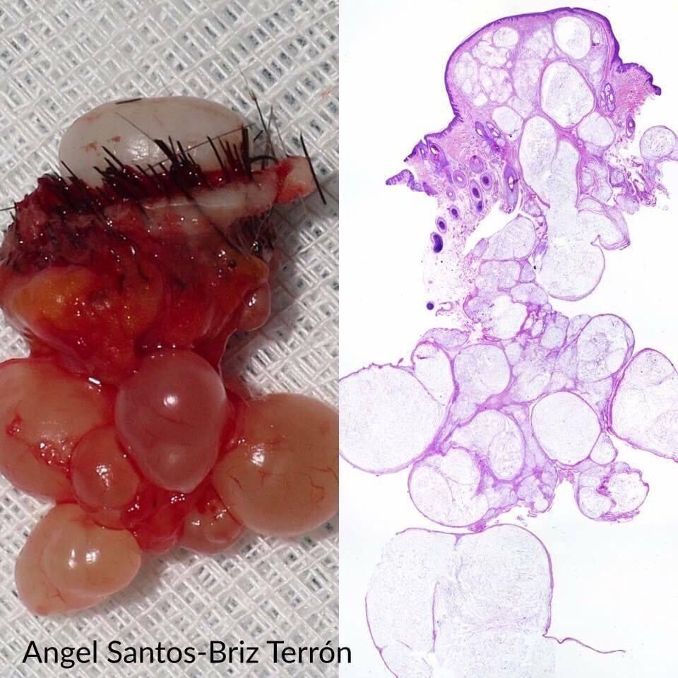 JMGardnerMD's tweet image. AMAZING #grosspath &amp;amp; #pathology pics by Dr Angel Santos-Briz
@ santosbriz
Answer: youtube.com/watch?v=FaWOul… 
More info: kikoxp.com/posts/20986
Another case: kikoxp.com/posts/16056
Video: youtube.com/watch?v=VUB-Vm… 
#pathTwitter #dermpath #dermatology #BSTpath #dermtwitter
