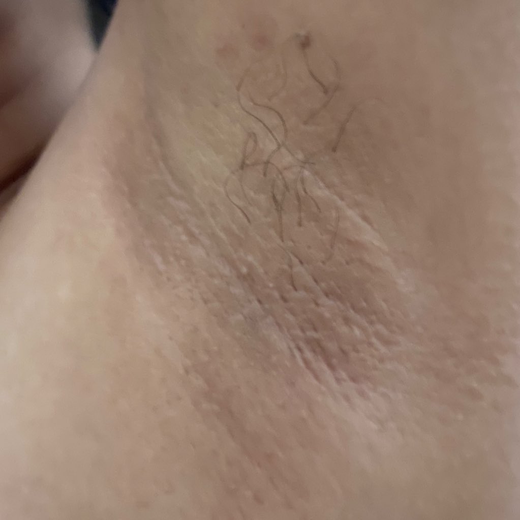 shopp_handeu's tweet image. Punya chicken skin emang normal, tapi kalau ada cara buat bikin kulit lebih halus dan mulus, kenapa enggak? ☺️🫶🏻 

Sini kumpul, aku spill rahasia minimalisirnya!