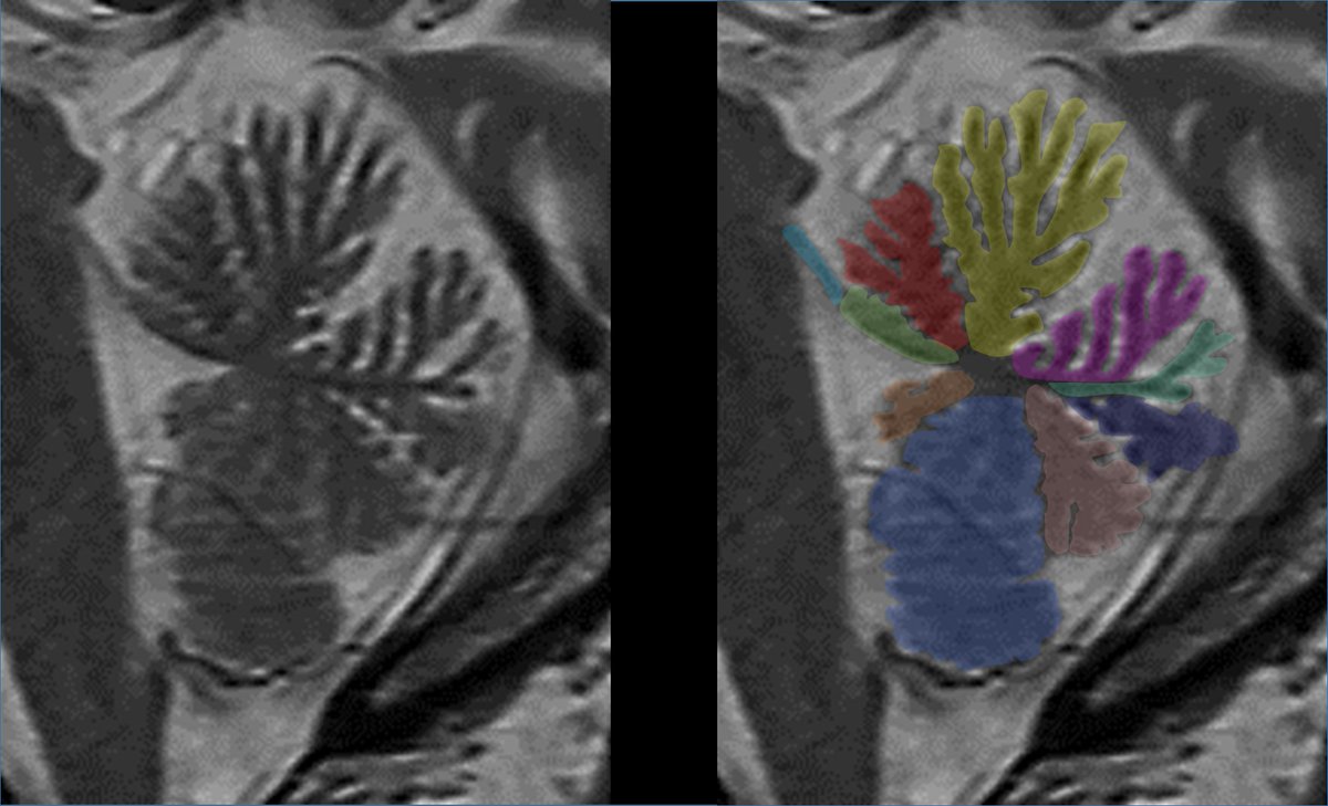 1/Is remembering cerebellar anatomy making you dizzy? 

Need help telling your flocculus from your nodule?

How much cerebellar anatomy do YOU know?

Here’s some help w/an anatomy thread on the 9 lobules of the vermis!